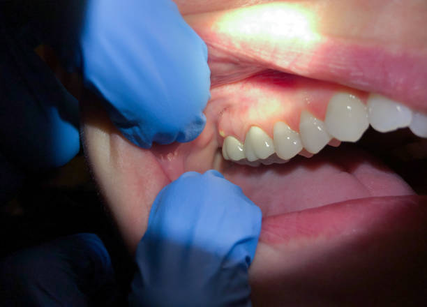 Best Emergency Wisdom Tooth Extraction in Oran, MO
